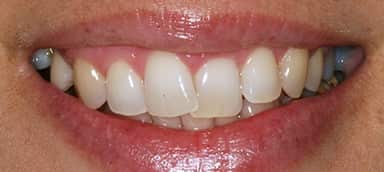 Photo of patient's teeth before and after