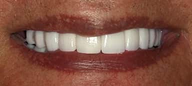 Photo of patient's teeth before and after